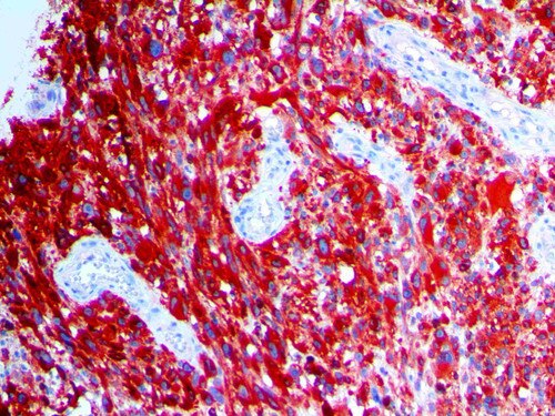 IHC of MART-1/Melan-A on a FFPE Melanoma Tissue